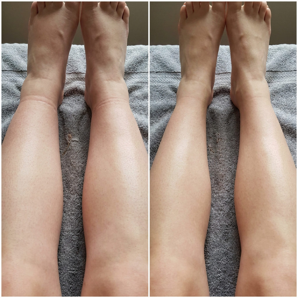 Chevilles avant après Drenae
